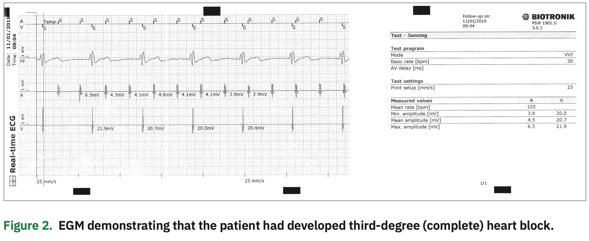 Instant Upgrade for SingleChamber ICD Patient with Heart Block